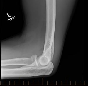150724 Elbow x-ray